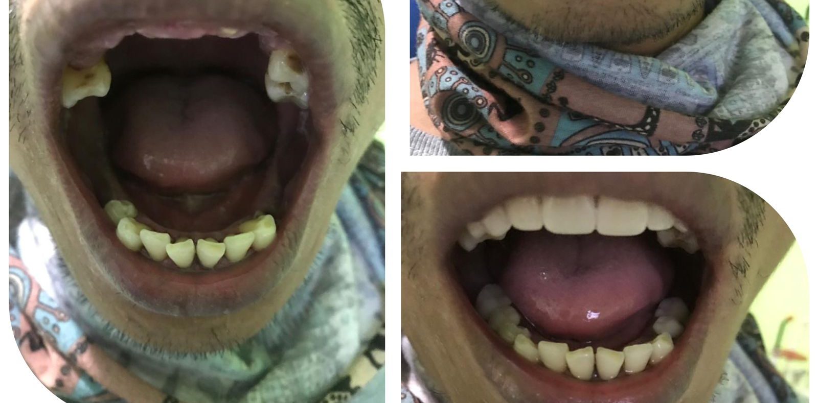 Ilustrasi Penyakit Gigi